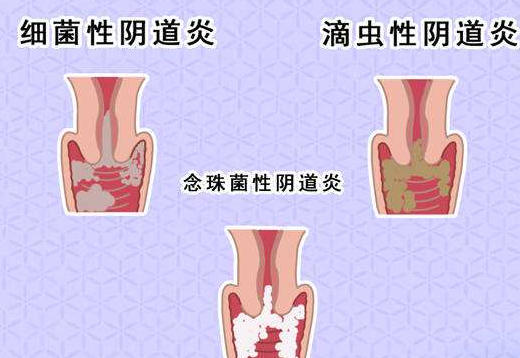 阴道分泌物JK漫画在线观看剖析什么是细菌性阴道炎