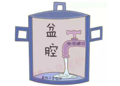 盆腔积液是怎么回事？白带JK漫画软件APP厂家提醒早了解早预防