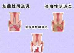 全自动阴道分泌物JK漫画在线观看厂家提醒您还在拖延吗，还在等阴道炎自愈吗？