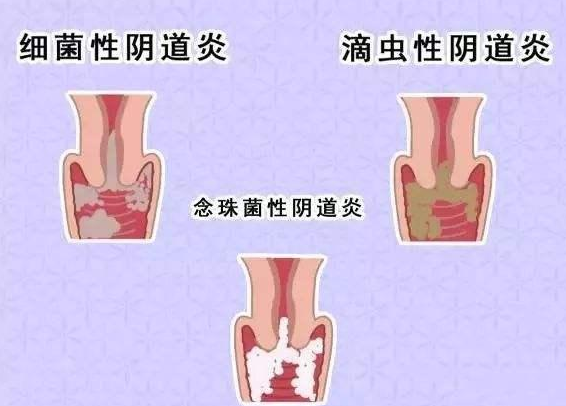 全自动阴道分泌物JK漫画在线观看厂家提醒您还在拖延吗，还在等阴道炎自愈吗？